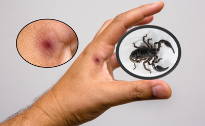 עקיצת עקרב | אילוסטרציה