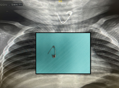 סיכת הביטחון ליד הושט - ולאחר שהוצאה בניתוח