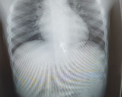 המשפחה הירושלמית מצאה את המפתח שנעלם בקיבת בן ה-7