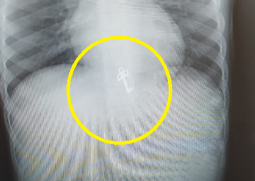 המפתח שנמצא בתוך הקיבה