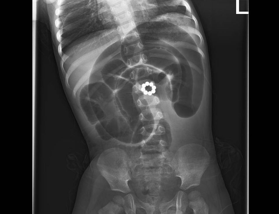 תמונת דימות של המגנטים במעי