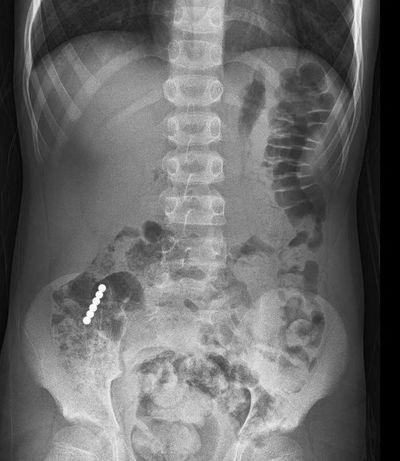 תמונת דימות של המגנטים במעי