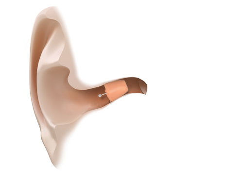 הכירו את דור העתיד של מכשירי השמיעה הזעירים