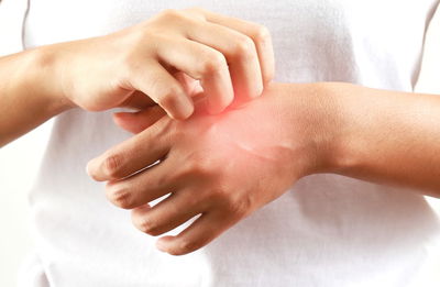 תפסיקו לגרד! גלו את התרסיס שימנע ממכם להיעקץ 