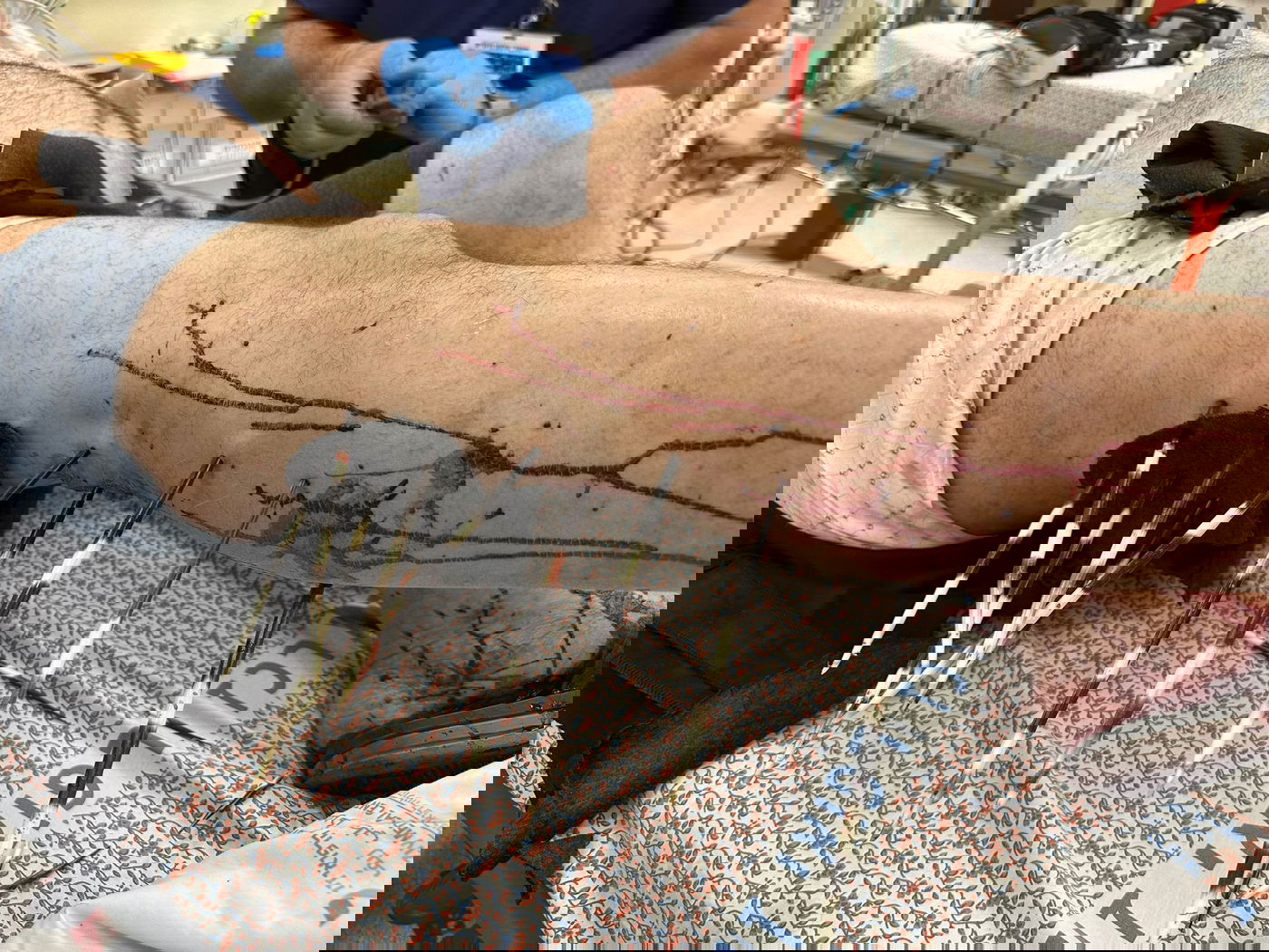 41 חצים של דורבן בגופו של תושב חצור הגלילית