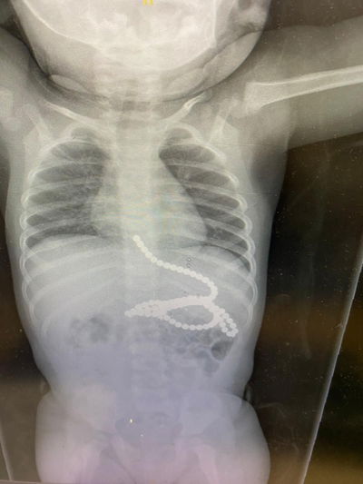 הרנטגן בו נראים המגנטים שבלע הפעוט