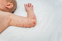 תסמיני החצבת