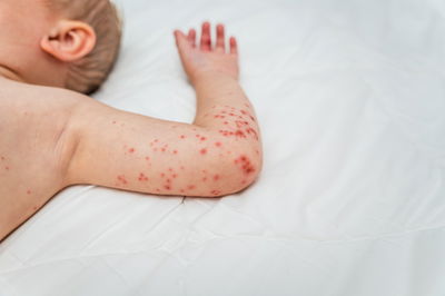 תסמיני החצבת