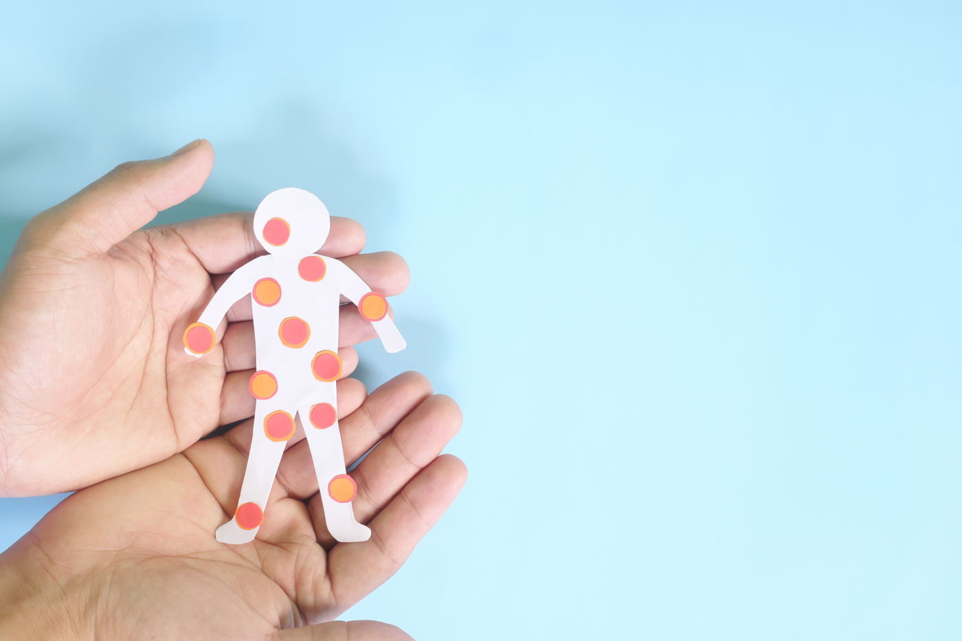 חלק מהתסמינים היא פריחה בגוף. חצבת