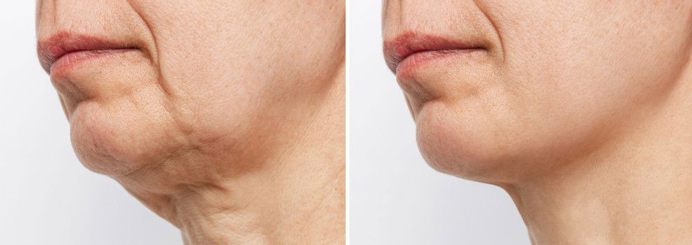 אחרי הטיפול היא מצאה את עצמה בגרסה רעננה