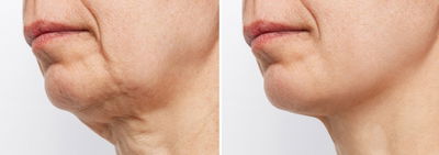 אחרי הטיפול היא מצאה את עצמה בגרסה רעננה