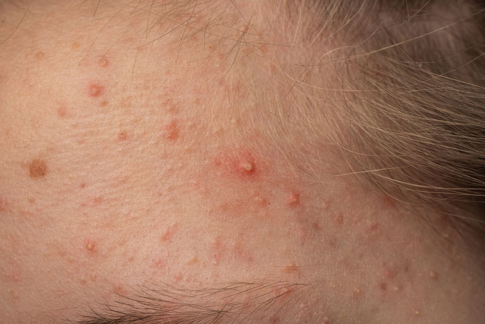 פצעי אקנה תמיד מגיעים בזמן הכי לא נכון