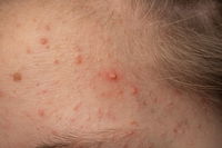 פצעי אקנה תמיד מגיעים בזמן הכי לא נכון