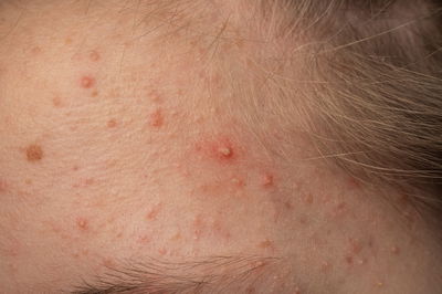 פצעי אקנה תמיד מגיעים בזמן הכי לא נכון