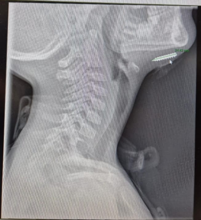 הבורג שננעץ בסנטר הילד