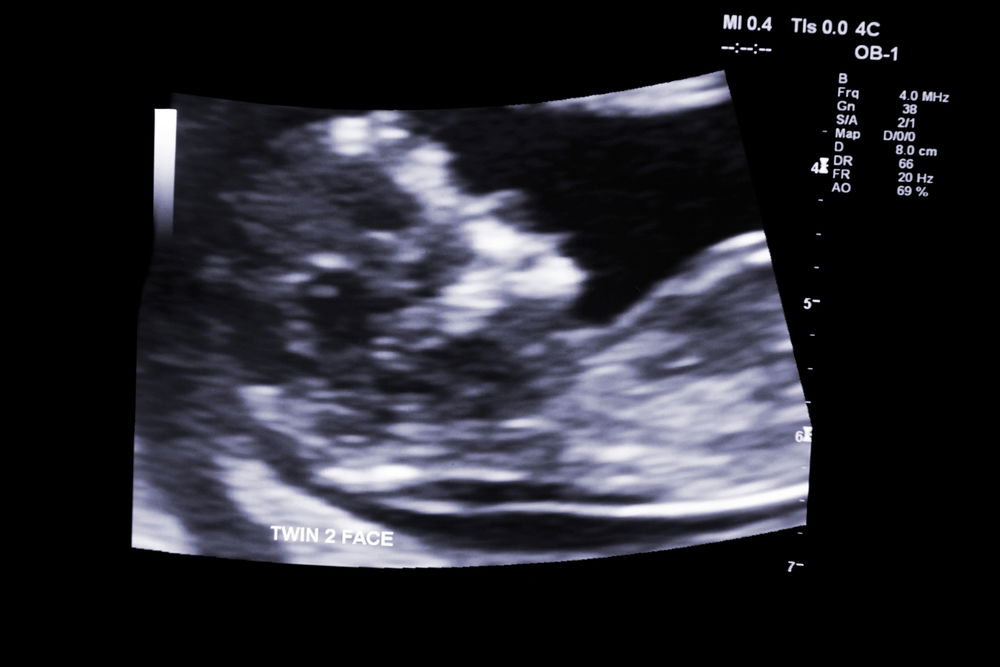 נדיר וכנראה חסר תקדים: אישה גילתה שהיא בהריון עם 9 עוברים