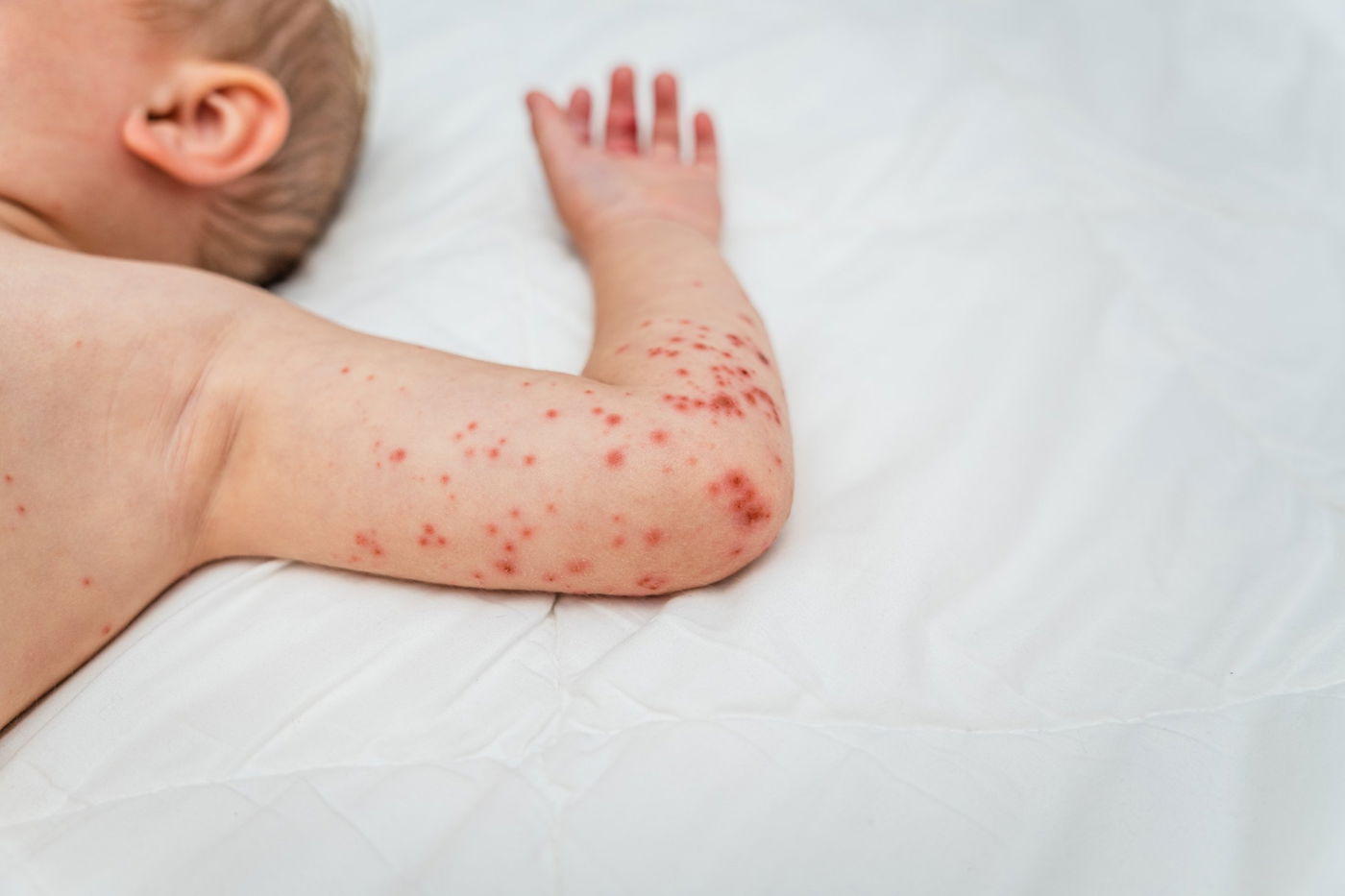 צילום: תסמיני החצבת