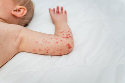 צילום: תסמיני החצבת