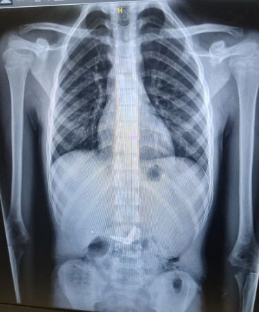 המספריים במצב פתוח בתוך הקיבה