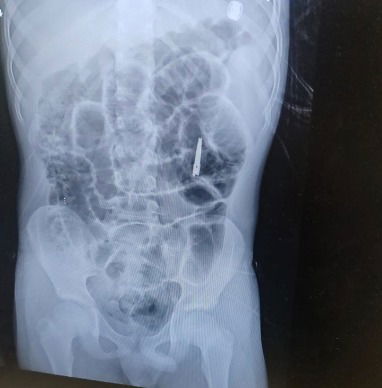 המספריים במצב סגור אחרי הקיבה