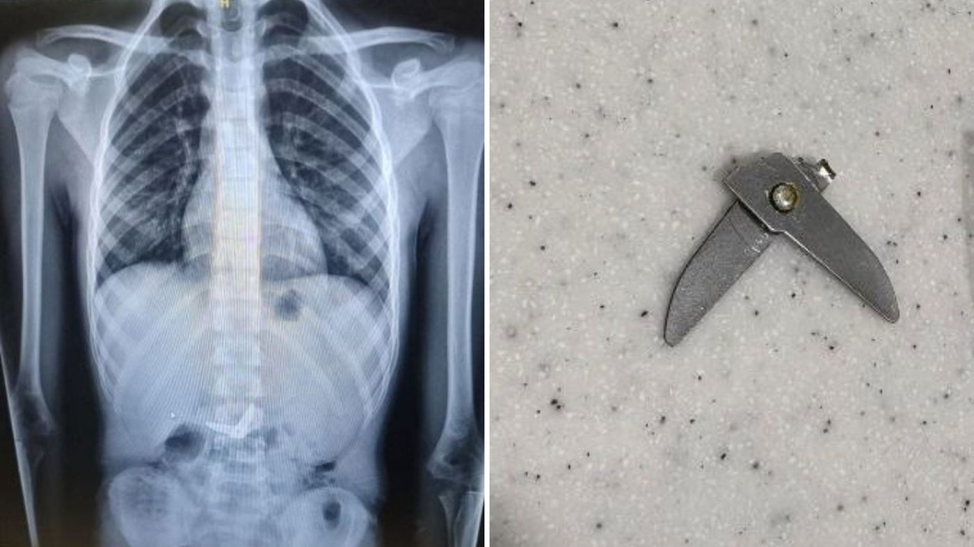 צילום רנטגן של המספריים, ואחרי שהם יצאו בשלום