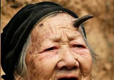 התופעה הנדירה: כך מצמיחים בני אדם קרניים