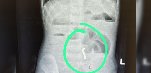 לא ייאמן: ילד בן 4 סבל מכאבי בטן והקאות - זה מה שנמצא בבדיקות המקיפות