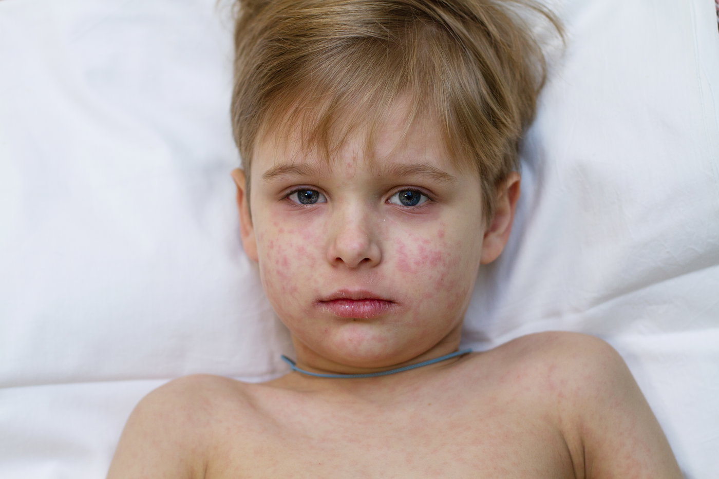 ילד חולה בחצבת