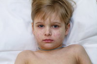 ילד חולה בחצבת