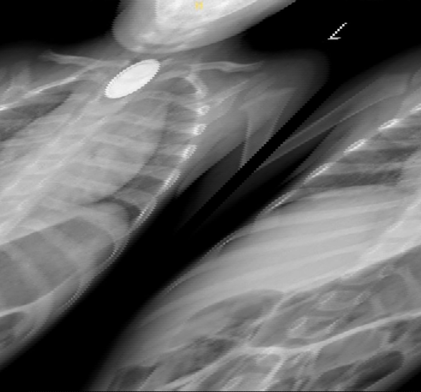 צילום הרנטגן שבו התגלתה הסוללה בוושט