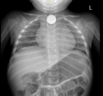 צילום הרנטגן שבו התגלתה הסוללה בוושט