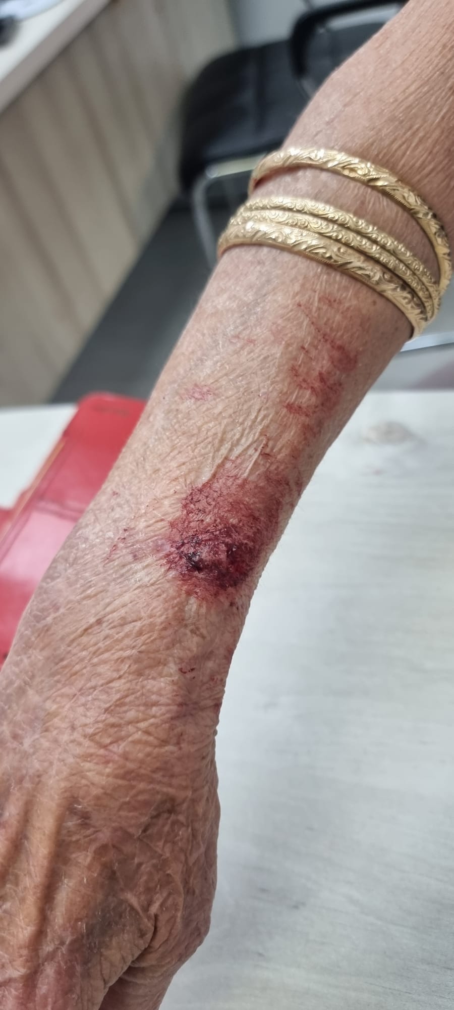 החבלה שנגרמה לקשישה