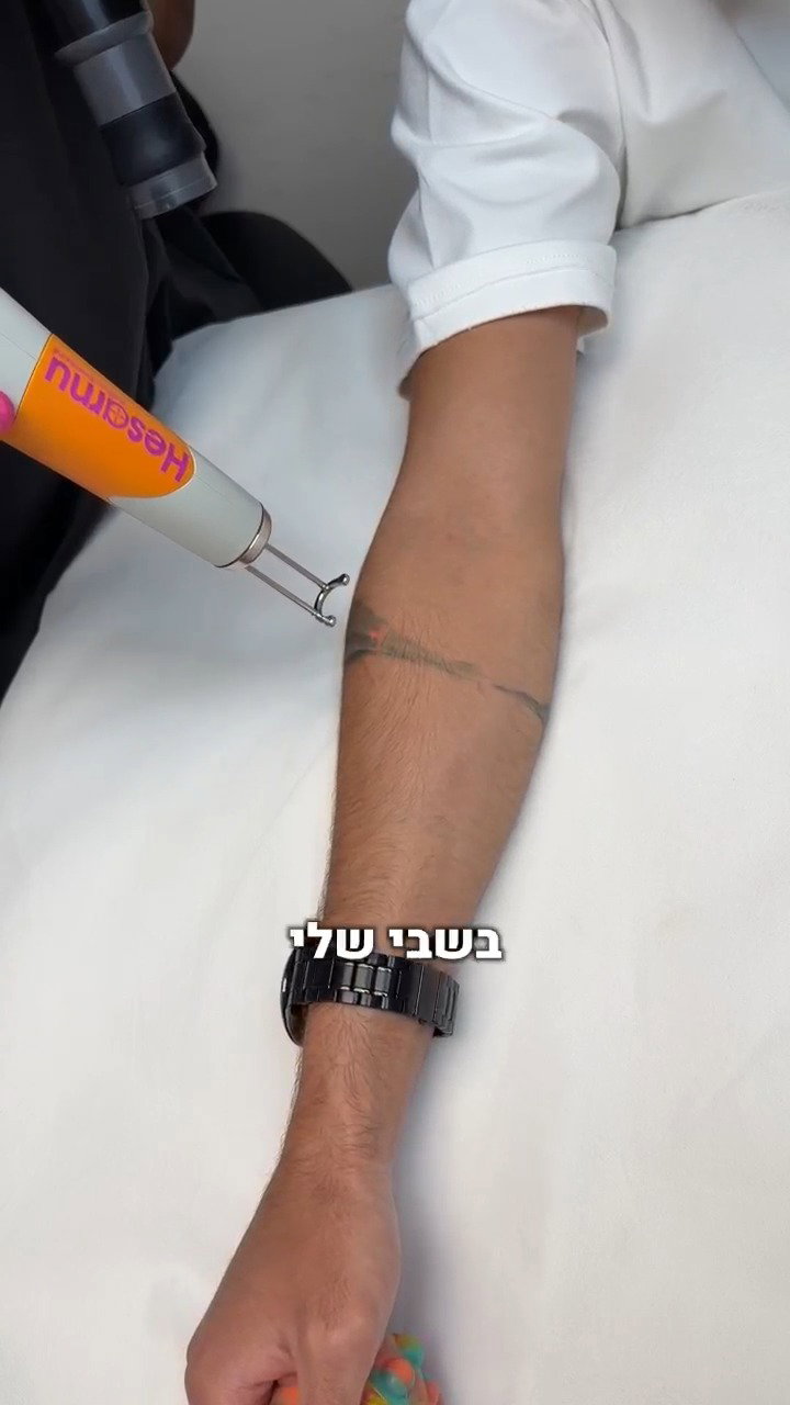 מסיר את הקעקוע | צפו
